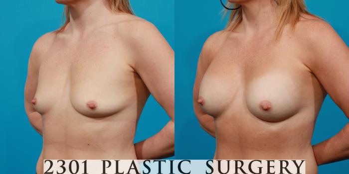 Before & After Silicone Implants Case 132 View #3 View in Fort Worth, Plano, & Frisco, Texas