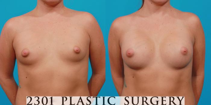 Before & After Silicone Implants Case 139 View #1 View in Fort Worth, Plano, & Frisco, Texas