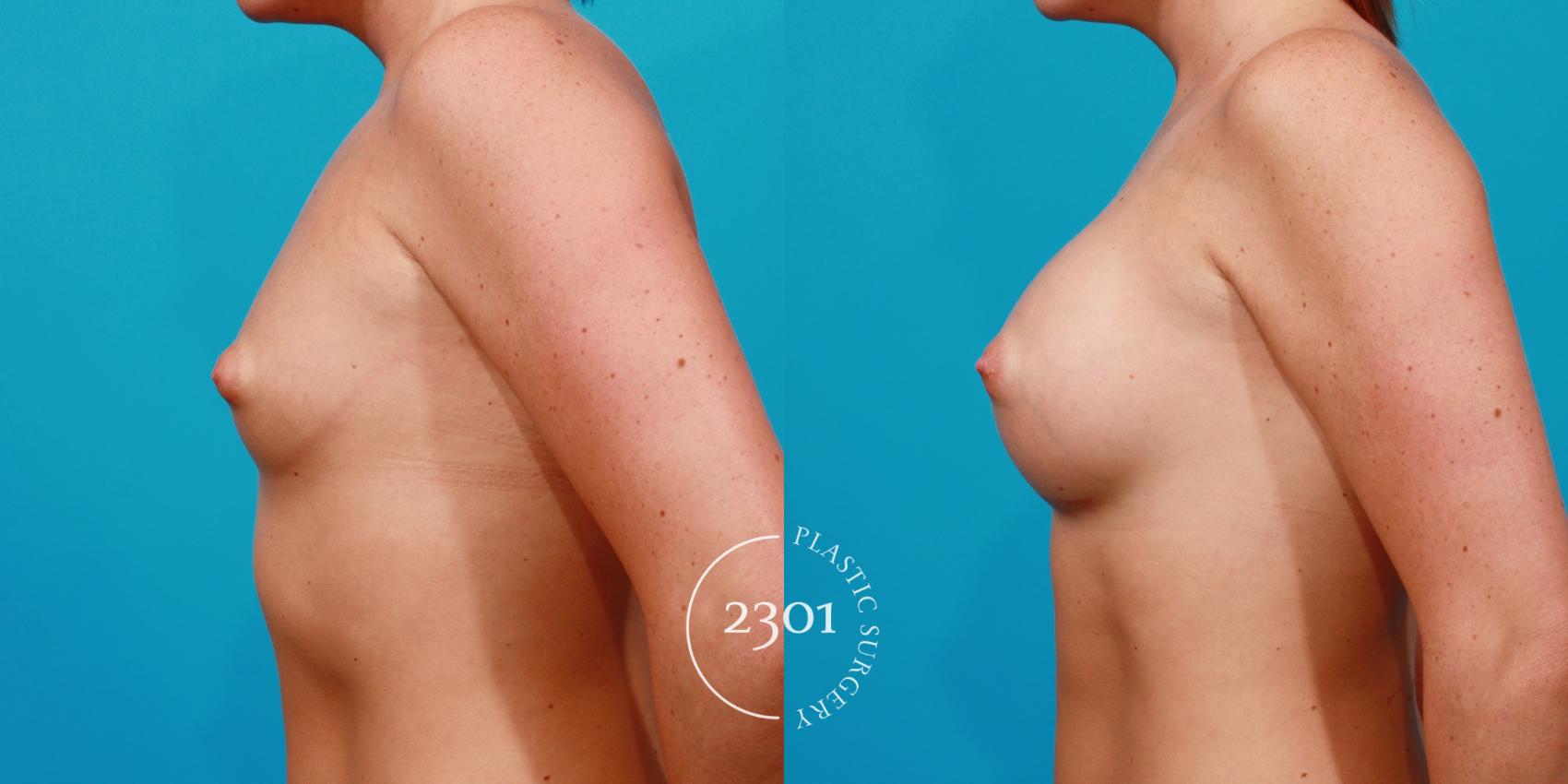 Before & After Silicone Implants Case 139 View #2 View in Fort Worth, Plano, & Frisco, Texas