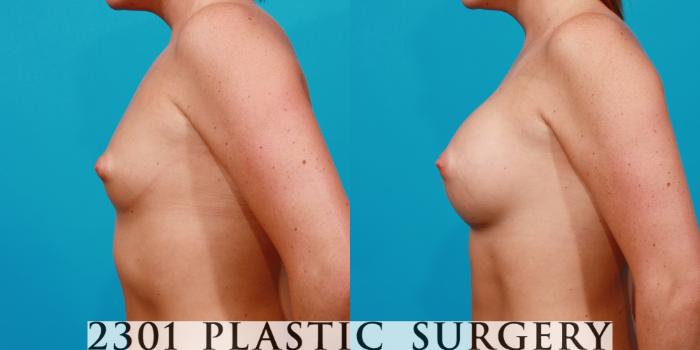 Before & After Silicone Implants Case 139 View #2 View in Fort Worth, Plano, & Frisco, Texas