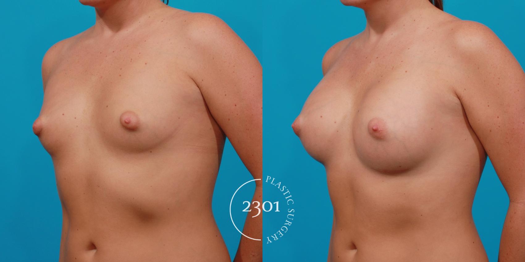 Before & After Silicone Implants Case 139 View #3 View in Fort Worth, Plano, & Frisco, Texas