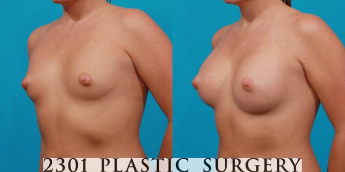 Before & After Silicone Implants Case 139 View #3 View in Fort Worth, Plano, & Frisco, Texas