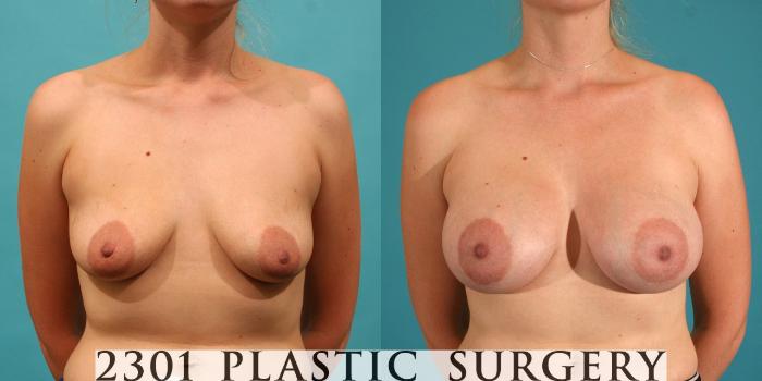Before & After Silicone Implants Case 14 View #1 View in Fort Worth, Plano, & Frisco, Texas