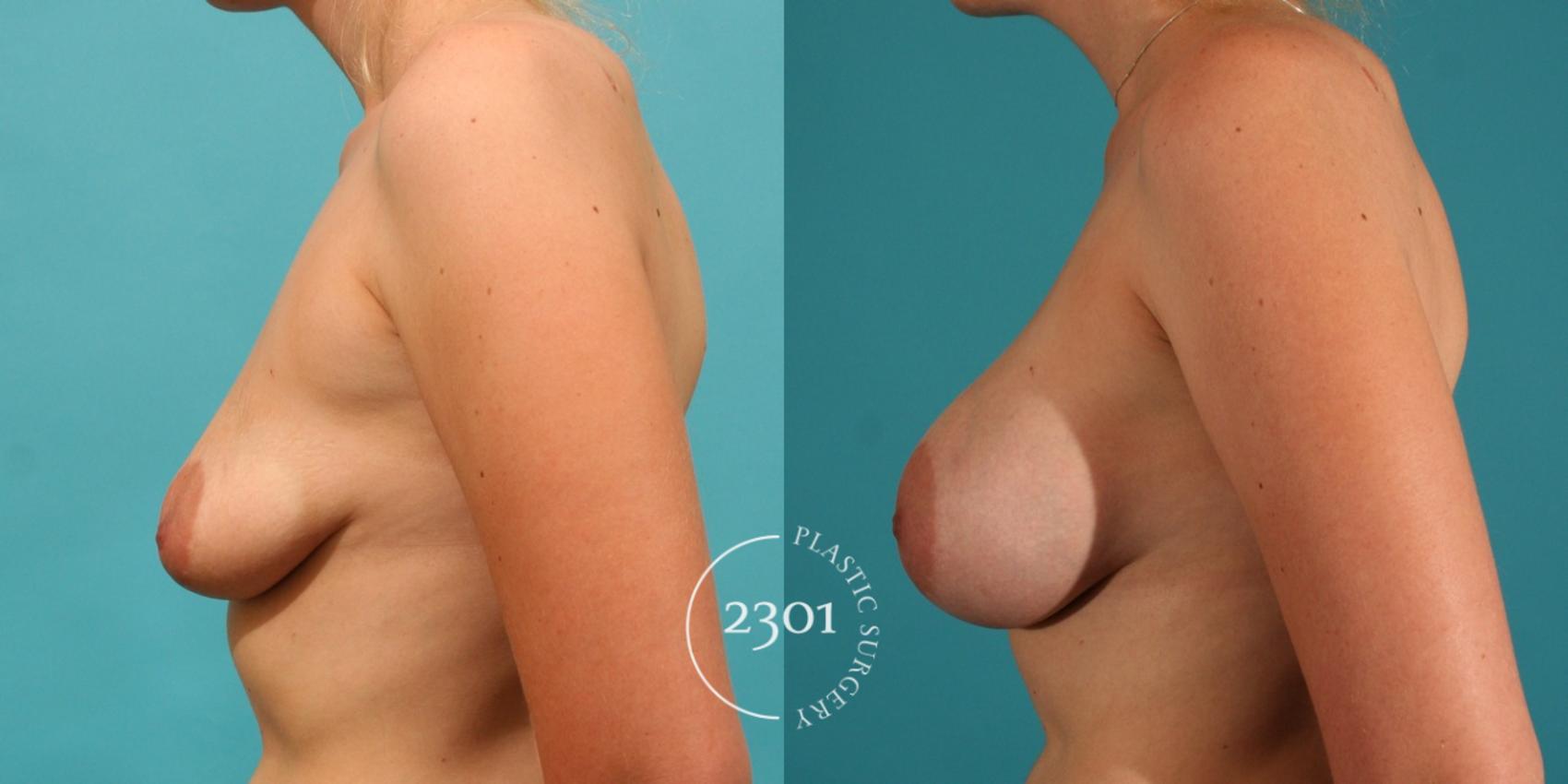 Before & After Silicone Implants Case 14 View #2 View in Fort Worth, Plano, & Frisco, Texas