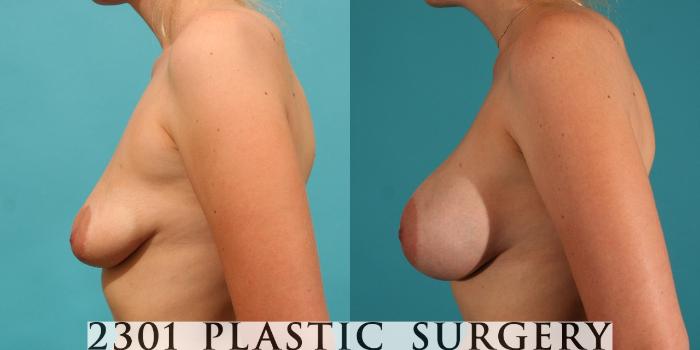 Before & After Silicone Implants Case 14 View #2 View in Fort Worth, Plano, & Frisco, Texas
