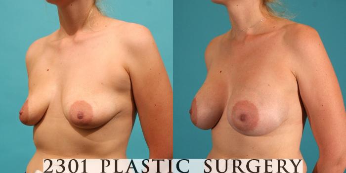 Before & After Silicone Implants Case 14 View #3 View in Fort Worth, Plano, & Frisco, Texas