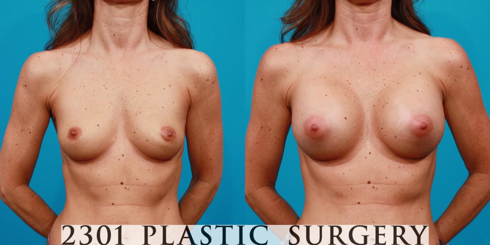 Before & After Silicone Implants Case 141 View #1 View in Fort Worth, Plano, & Frisco, Texas