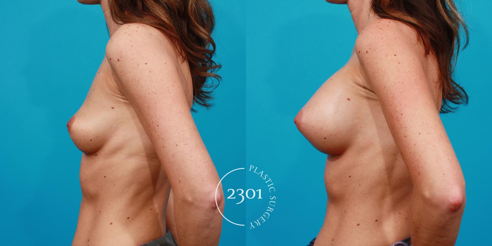 Before & After Breast Augmentation Case 141 View #2 View in Fort Worth, Plano, & Frisco, Texas