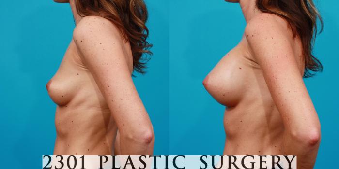 Before & After Silicone Implants Case 141 View #2 View in Fort Worth, Plano, & Frisco, Texas