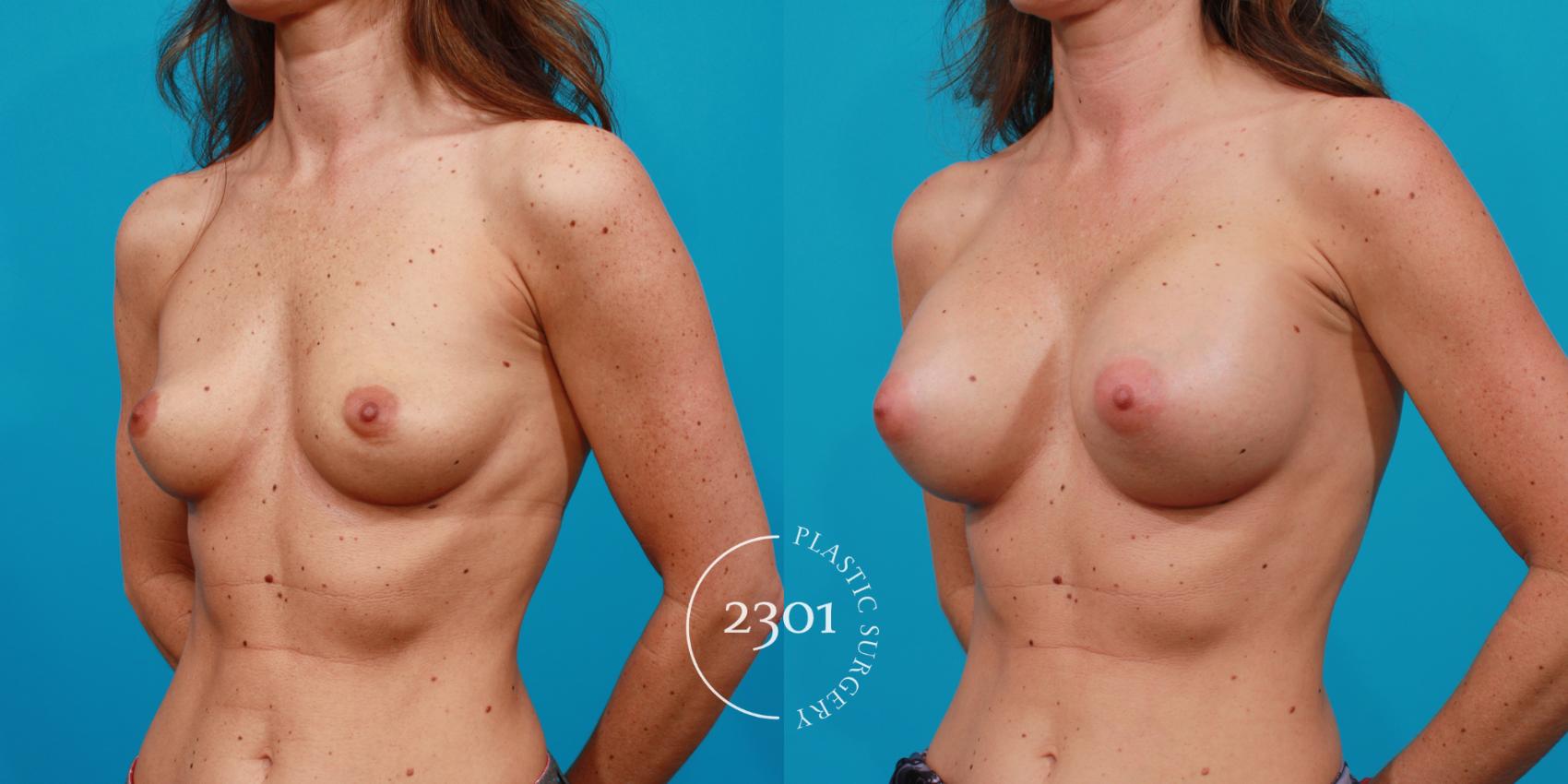 Before & After Breast Augmentation Case 141 View #3 View in Fort Worth, Plano, & Frisco, Texas