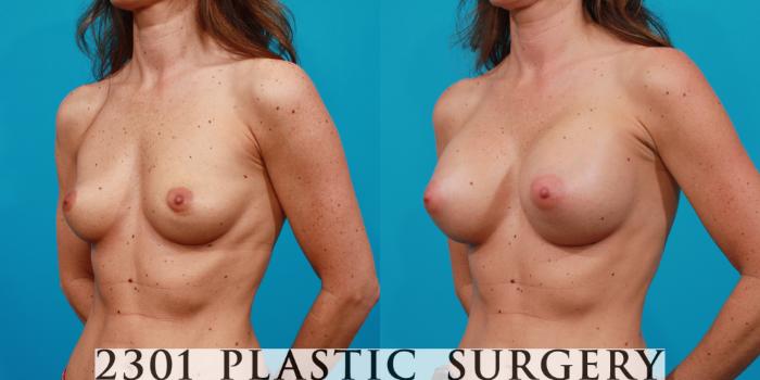 Before & After Silicone Implants Case 141 View #3 View in Fort Worth, Plano, & Frisco, Texas