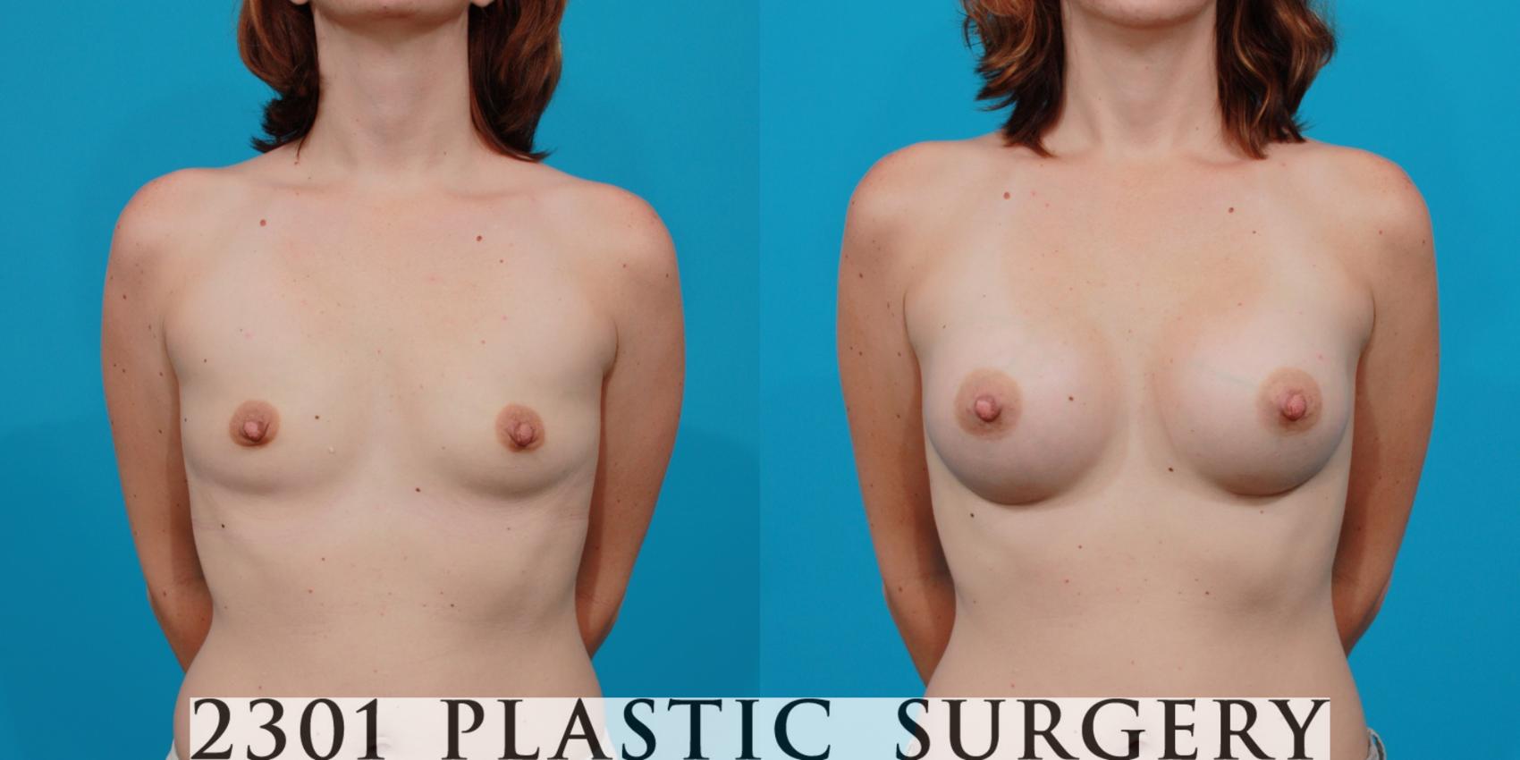 Before & After Breast Augmentation Case 142 View #1 View in Fort Worth, Plano, & Frisco, Texas