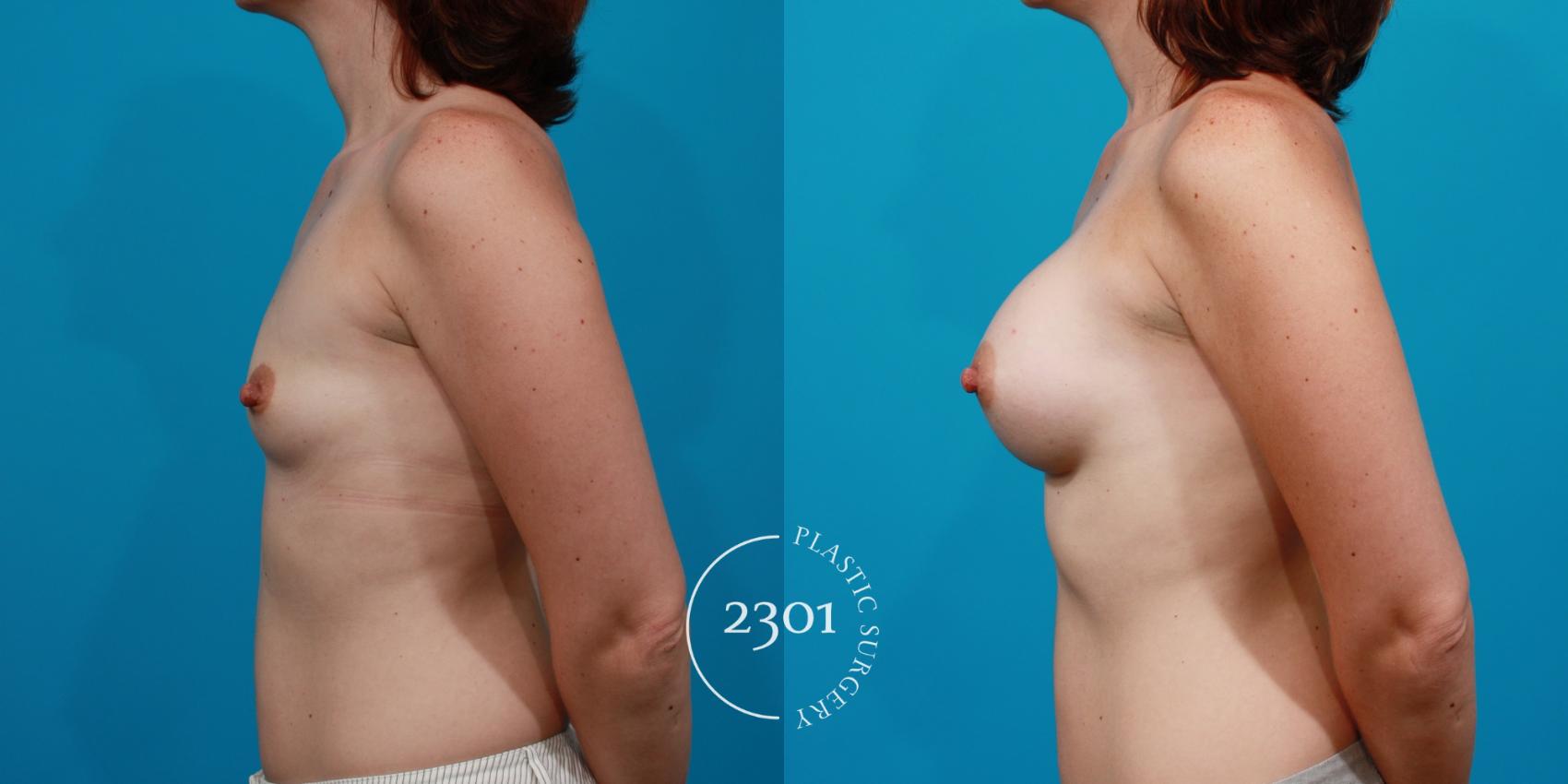 Before & After Silicone Implants Case 142 View #2 View in Fort Worth, Plano, & Frisco, Texas