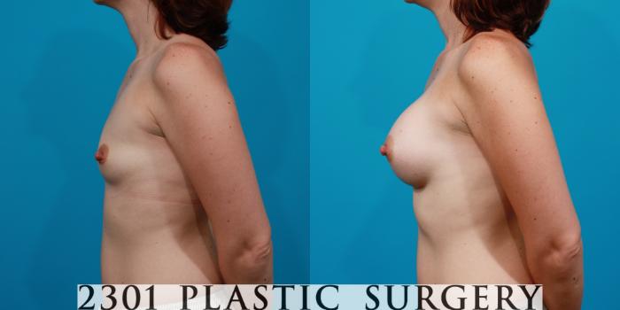 Before & After Breast Augmentation Case 142 View #2 View in Fort Worth, Plano, & Frisco, Texas