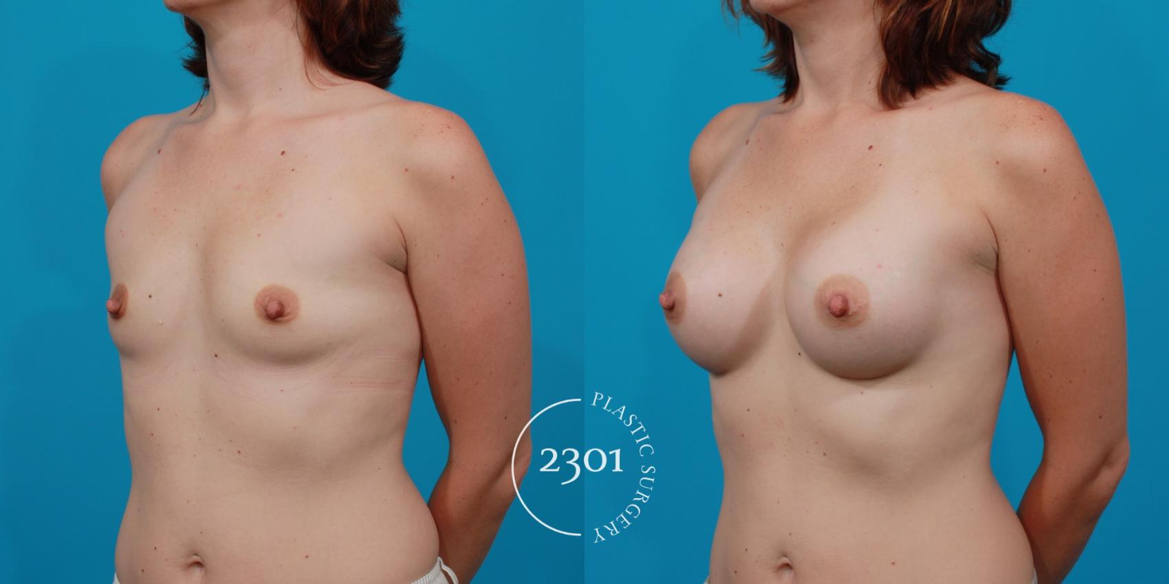 Before & After Silicone Implants Case 142 View #3 View in Fort Worth, Plano, & Frisco, Texas