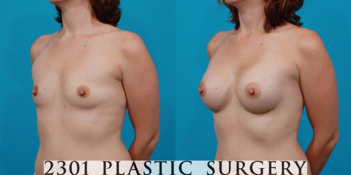 Before & After Breast Augmentation Case 142 View #3 View in Fort Worth, Plano, & Frisco, Texas