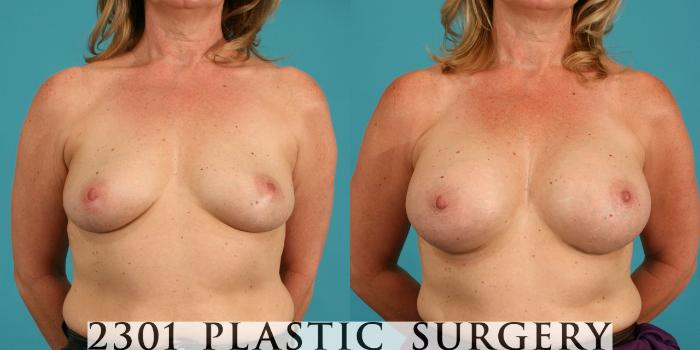 Before & After Silicone Implants Case 15 View #1 View in Fort Worth, Plano, & Frisco, Texas