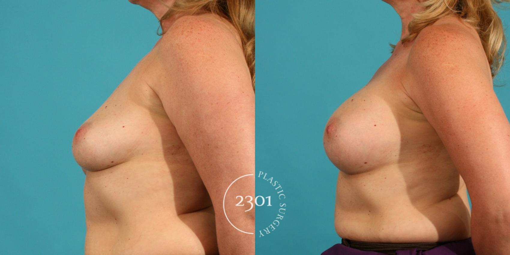 Before & After Silicone Implants Case 15 View #2 View in Fort Worth, Plano, & Frisco, Texas