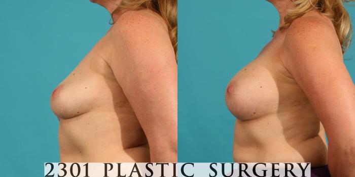 Before & After Silicone Implants Case 15 View #2 View in Fort Worth, Plano, & Frisco, Texas