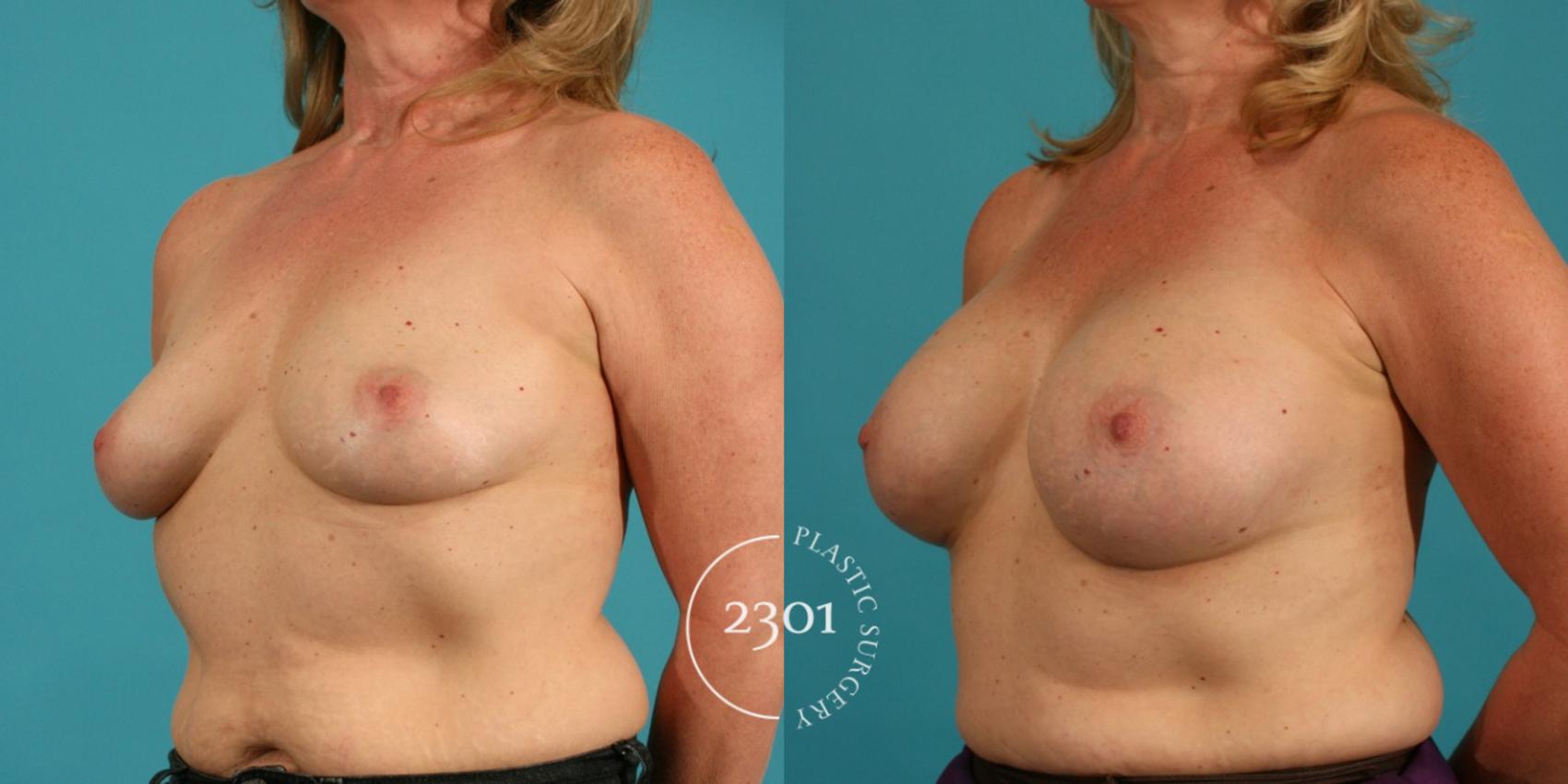 Before & After Silicone Implants Case 15 View #3 View in Fort Worth, Plano, & Frisco, Texas