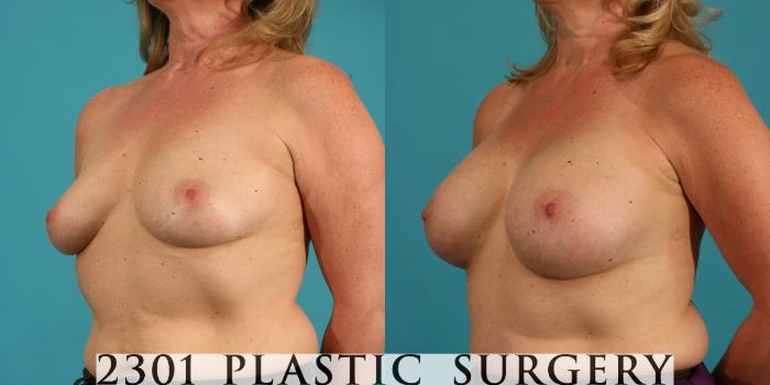 Before & After Breast Augmentation Case 15 View #3 View in Fort Worth, Plano, & Frisco, Texas