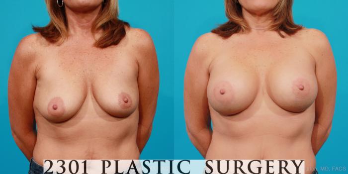 Before & After Silicone Implants Case 157 View #1 View in Fort Worth, Plano, & Frisco, Texas