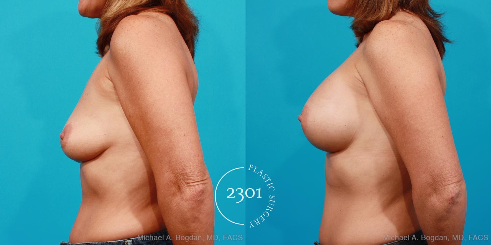 Before & After Silicone Implants Case 157 View #2 View in Fort Worth, Plano, & Frisco, Texas