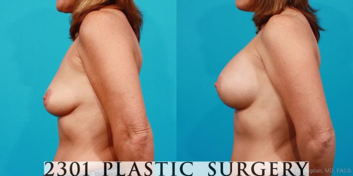 Before & After Silicone Implants Case 157 View #2 View in Fort Worth, Plano, & Frisco, Texas