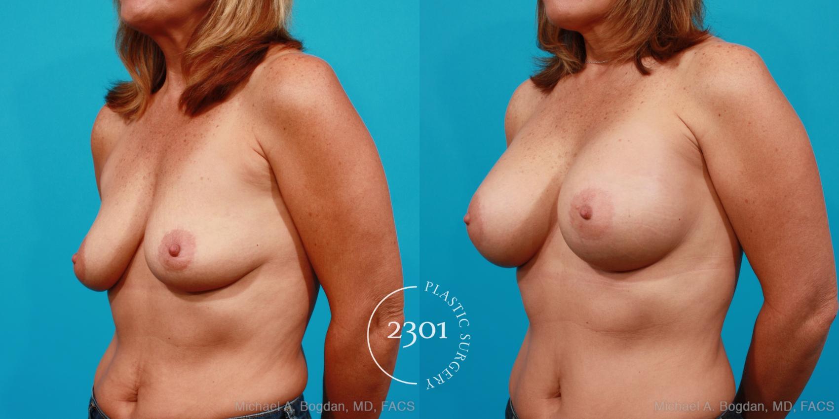 Before & After Silicone Implants Case 157 View #3 View in Fort Worth, Plano, & Frisco, Texas