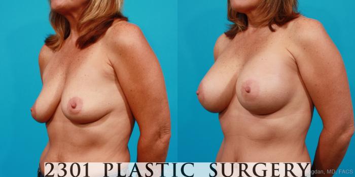Before & After Silicone Implants Case 157 View #3 View in Fort Worth, Plano, & Frisco, Texas