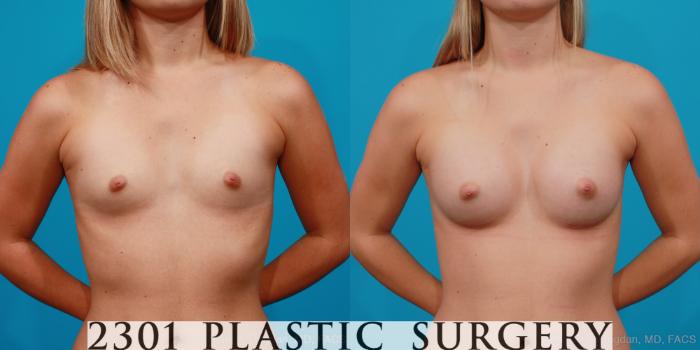 Before & After Silicone Implants Case 161 View #1 View in Fort Worth, Plano, & Frisco, Texas