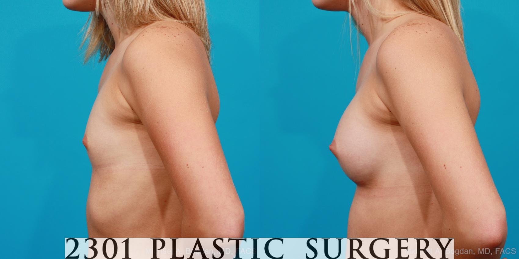 Before & After Silicone Implants Case 161 View #2 View in Fort Worth & Frisco, Texas