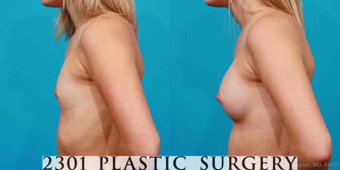 Before & After Silicone Implants Case 161 View #2 View in Fort Worth, Plano, & Frisco, Texas