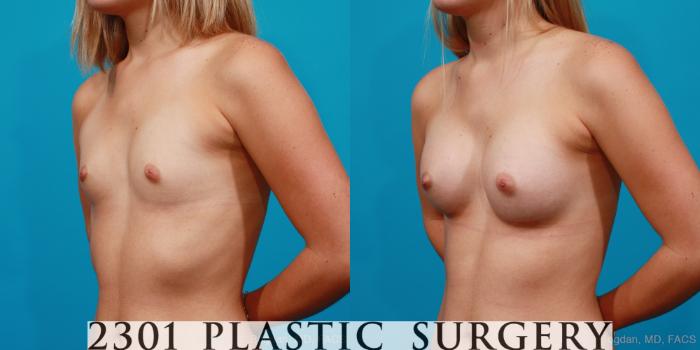 Before & After Silicone Implants Case 161 View #3 View in Fort Worth, Plano, & Frisco, Texas
