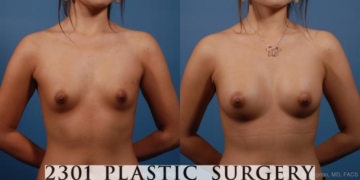 Before & After Silicone Implants Case 162 View #1 View in Fort Worth, Plano, & Frisco, Texas