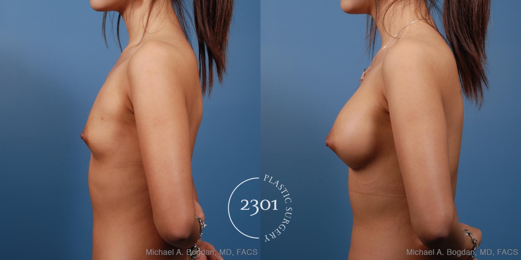 Before & After Silicone Implants Case 162 View #2 View in Fort Worth, Plano, & Frisco, Texas
