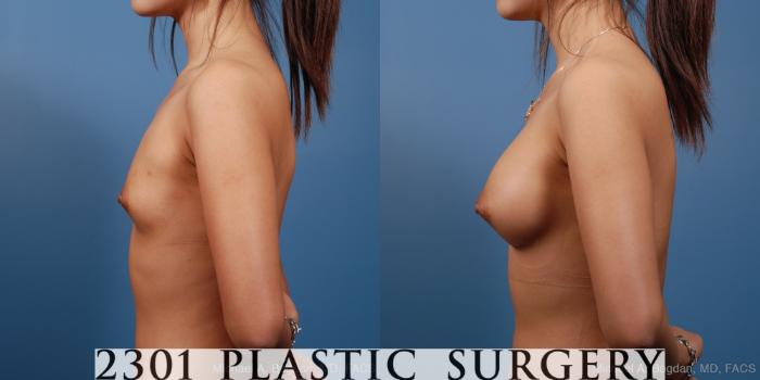 Before & After Silicone Implants Case 162 View #2 View in Fort Worth, Plano, & Frisco, Texas
