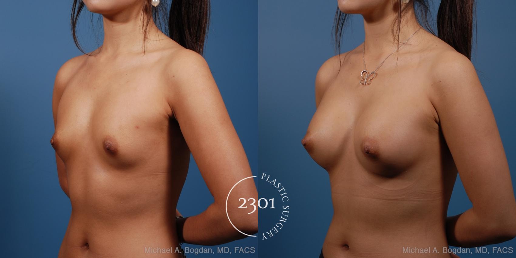 Before & After Silicone Implants Case 162 View #3 View in Fort Worth, Plano, & Frisco, Texas