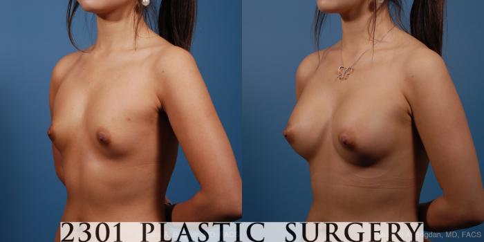 Before & After Silicone Implants Case 162 View #3 View in Fort Worth, Plano, & Frisco, Texas