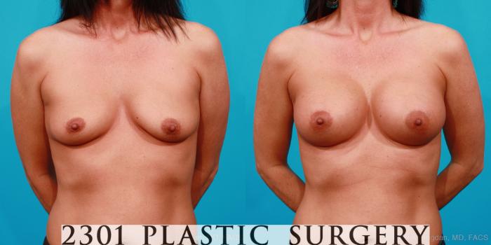 Before & After Silicone Implants Case 163 View #1 View in Fort Worth, Plano, & Frisco, Texas