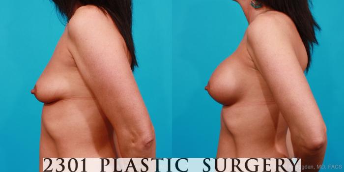 Before & After Silicone Implants Case 163 View #2 View in Fort Worth, Plano, & Frisco, Texas