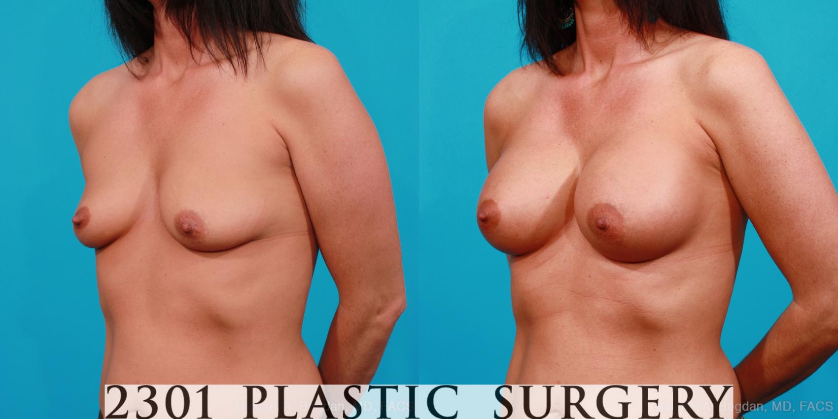 Before & After Silicone Implants Case 163 View #3 View in Fort Worth & Frisco, Texas
