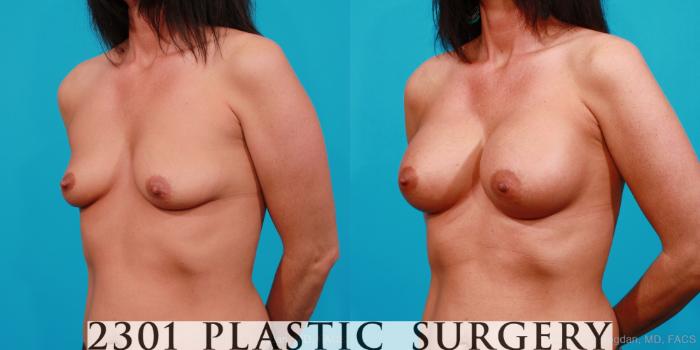 Before & After Silicone Implants Case 163 View #3 View in Fort Worth, Plano, & Frisco, Texas