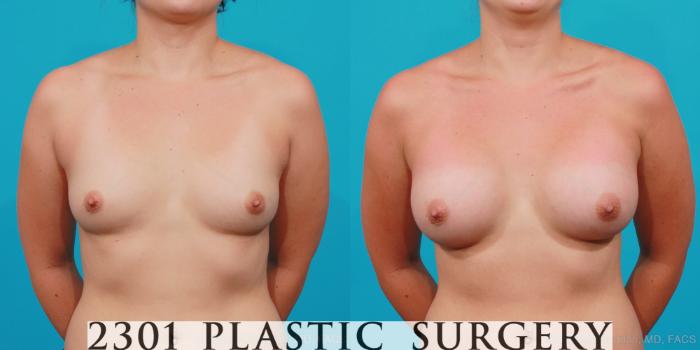 Before & After Breast Augmentation Case 174 View #1 View in Fort Worth, Plano, & Frisco, Texas
