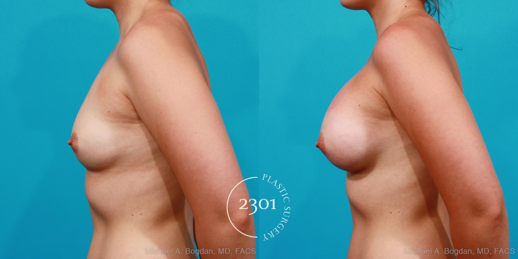 Before & After Silicone Implants Case 174 View #2 View in Fort Worth, Plano, & Frisco, Texas