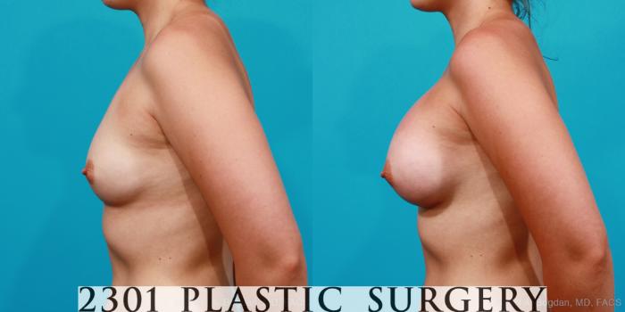 Before & After Silicone Implants Case 174 View #2 View in Fort Worth, Plano, & Frisco, Texas