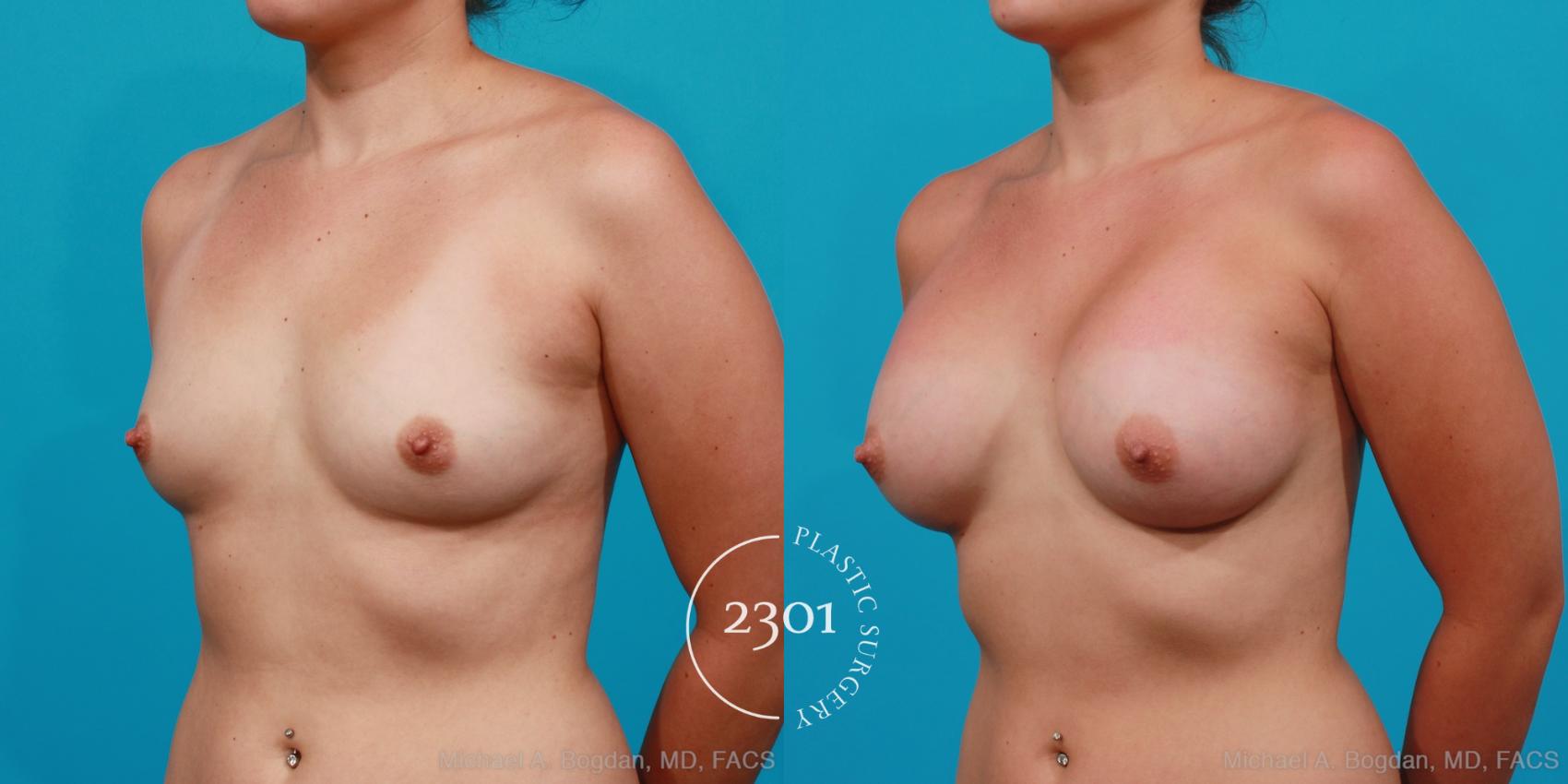 Before & After Silicone Implants Case 174 View #3 View in Fort Worth, Plano, & Frisco, Texas