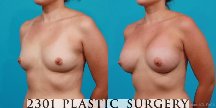 Before & After Silicone Implants Case 174 View #3 View in Fort Worth, Plano, & Frisco, Texas