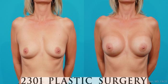 Before & After Silicone Implants Case 176 View #1 View in Fort Worth, Plano, & Frisco, Texas