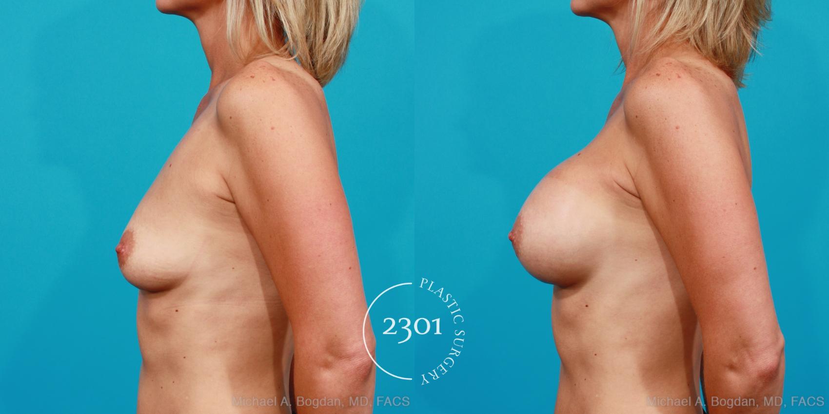 Before & After Silicone Implants Case 176 View #2 View in Fort Worth, Plano, & Frisco, Texas